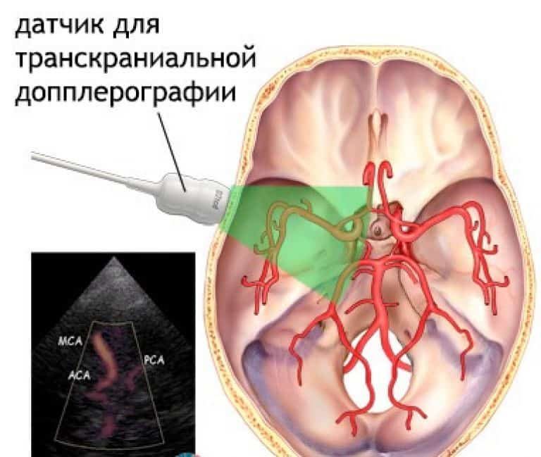 Транскраниальное сканирование сосудов головного мозга