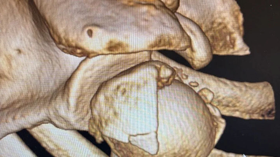 От кадавера до операционной: в Тульской областной клинической больнице начали делать сложнейшее эндопротезирование плеча