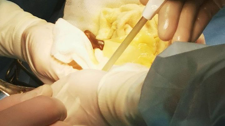 Хирурги областной больницы спасли жизнь 48-летнему туляку
