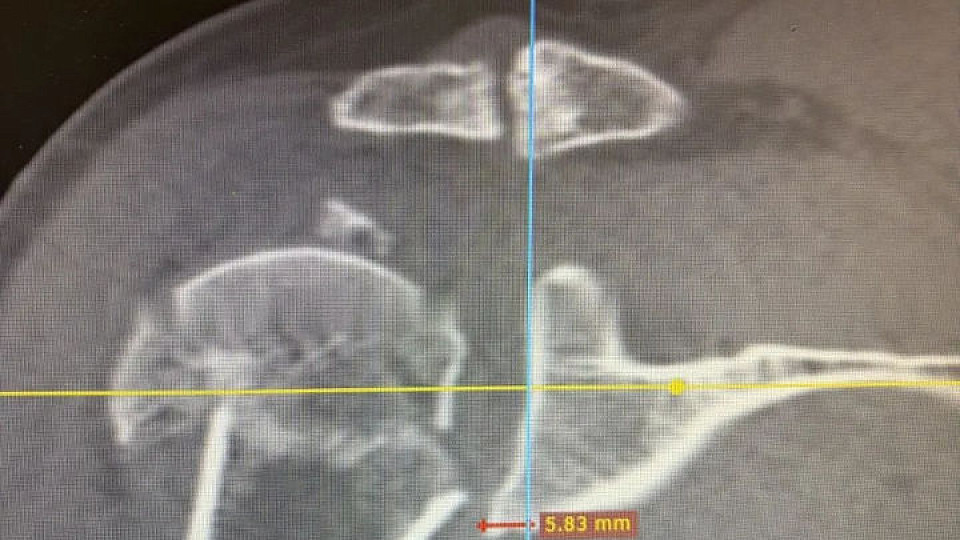 От кадавера до операционной: в Тульской областной клинической больнице начали делать сложнейшее эндопротезирование плеча